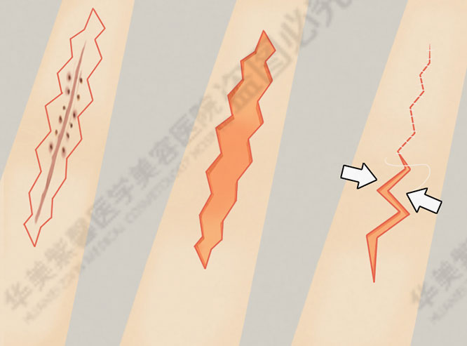 疤痕切除术